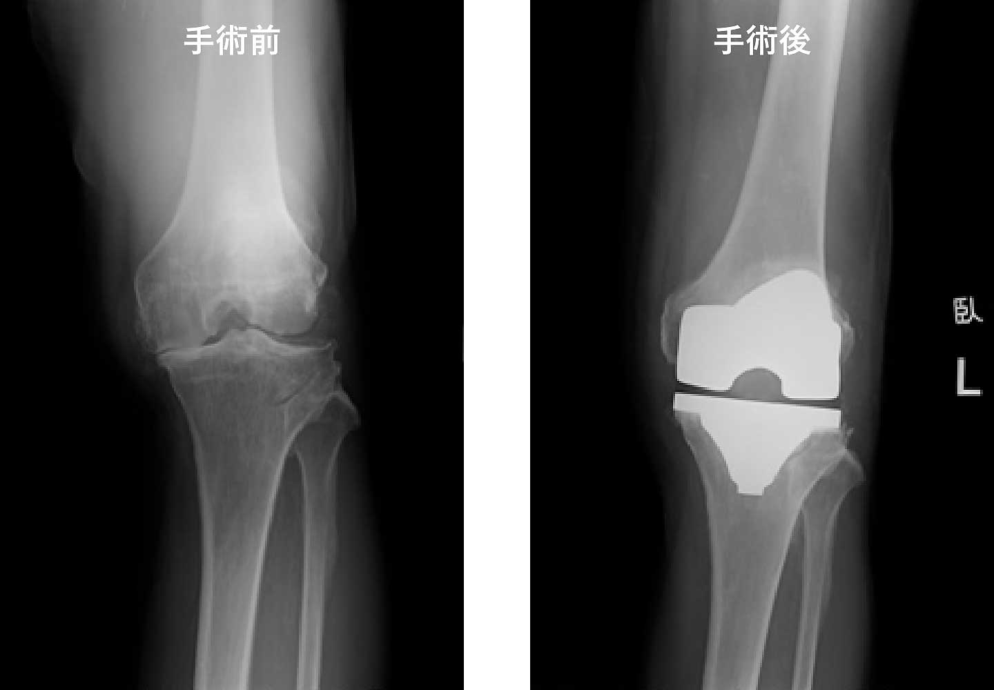 膝関節疾患 福岡豊栄会病院